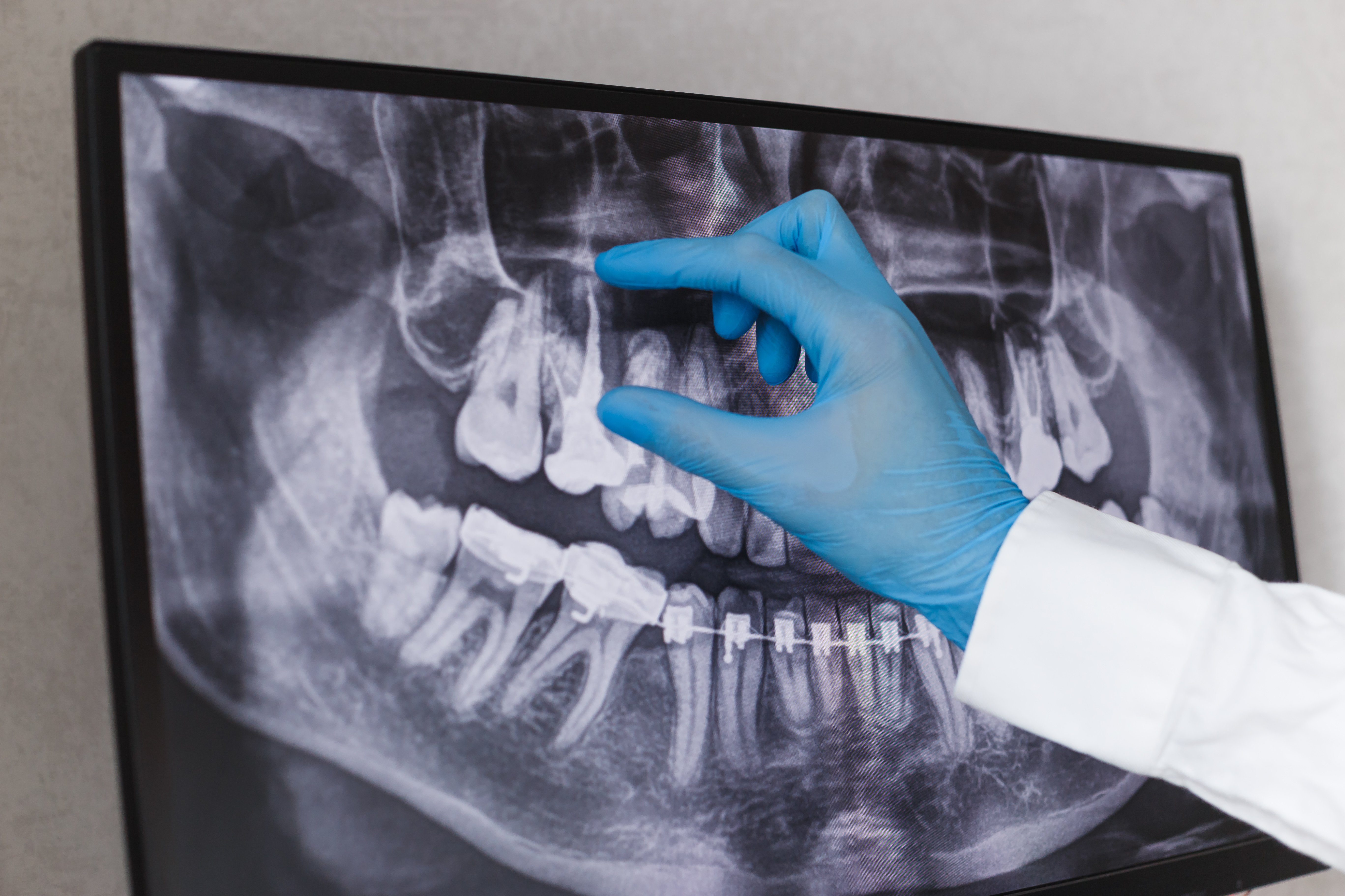 doctor-points-to-filled-root-canal-in-dental-x-ray-RH6E9R6