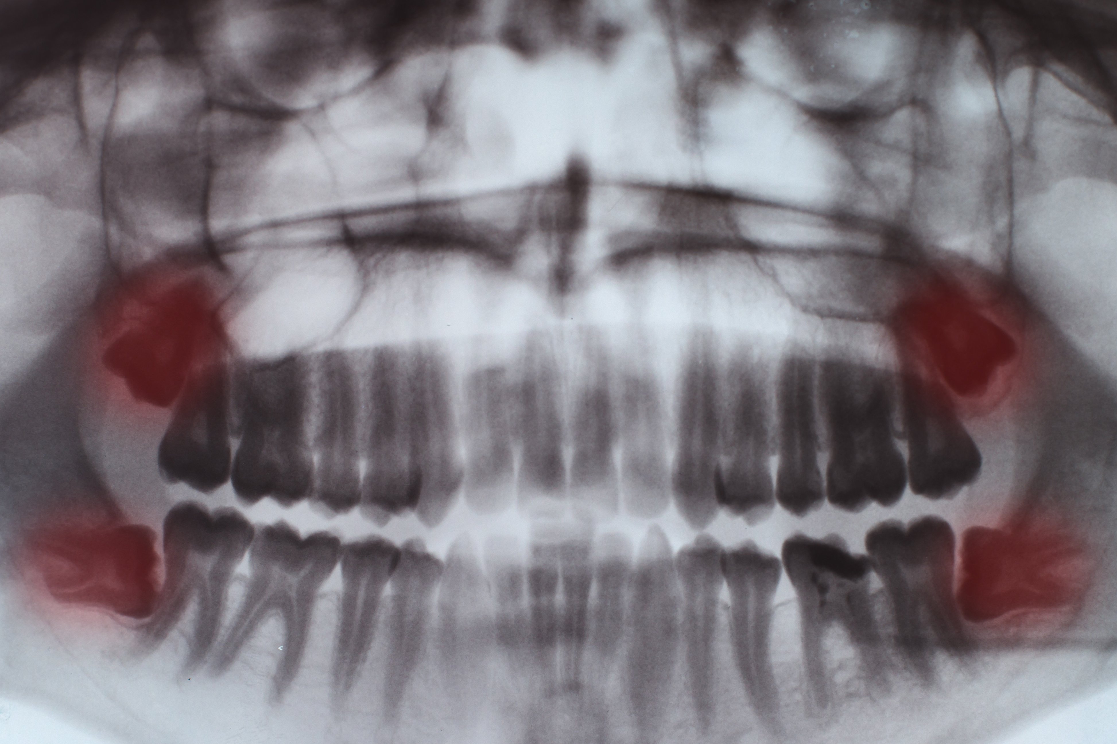 teeth-full-x-ray-FUGEHH8