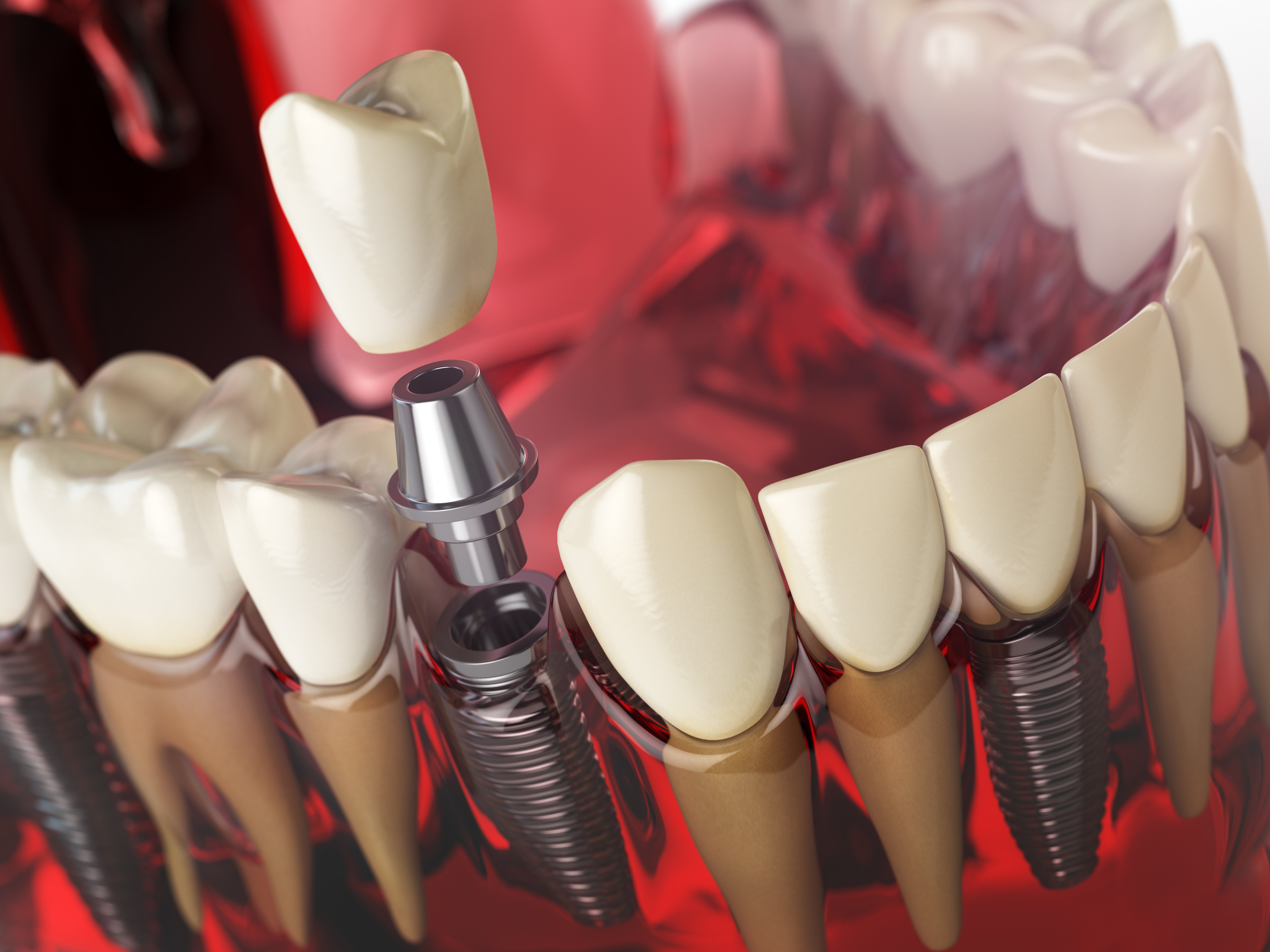 Tooth implant in the model of human teeth gums and denture