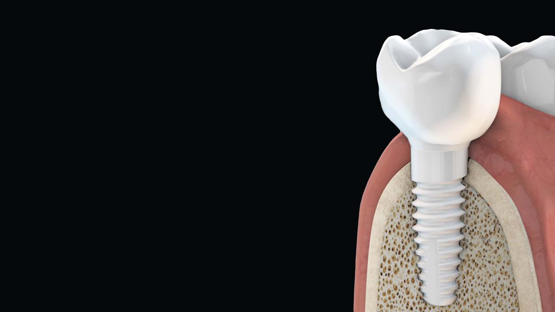 Metal Free Dental Implants